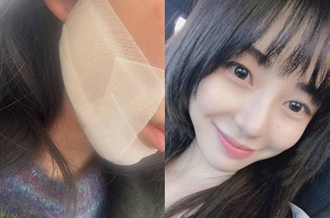 권민아가 피부과 시술 부작용 후 심정을 고백했다. /사진=인스타그램 갈무리