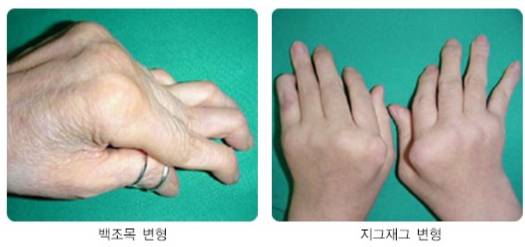 류마티스관절염 환자의 손목·손가락 관절이 변형된 모습. /자료=국가건강정보포털