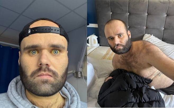 18세부터 음주를 시작해 20대 초반에 하루 와인 여섯 병과 보드카를 수 L씩 마시던 남성이 27세에 간염, 간경변, 신장 손상, 비장 염증, 췌장염을 동시에 진단받은 사연이 전해졌다. 사진=케네디뉴스앤미디어