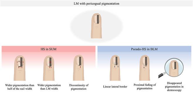 악성 흑색종(SUM)의 허친슨 징후(좌)와 양성 조갑흑색선조(BLM)의 가성 허친슨 징후(우) 간의6가지 임상적 차이 모식도./경북대학교병원 제공