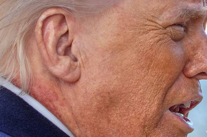 [워싱턴=AP/뉴시스] 도널드 트럼프 미국 대통령이 2월 27일(현지 시간) 워싱턴 백악관에서 마린원 헬기 탑승 전 기자들과 이야기 하고 있다. 그의 오른쪽 목에 붉은 반점이 보이고 있다. 2026.03.03.