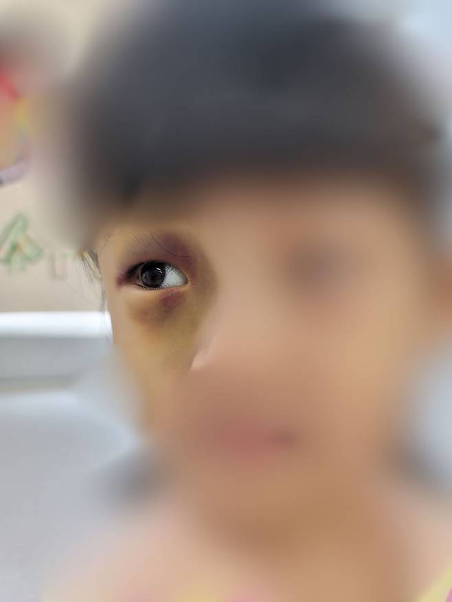 서윤(가명)이 눈가에 생긴 멍. 독자 제공