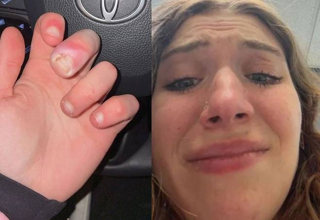 흔한 '이 행동' 탓, 손가락 절단 위기 처한 20대 女… 대체 무슨 일?