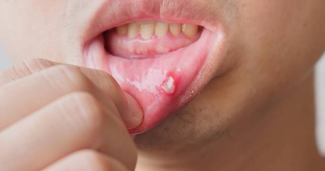 입안 상처가 2주 이상 낫지 않거나 혀·잇몸에 원인 모를 출혈과 통증이 나타난다면 구강암 초기 신호일 수 있어 즉각적인 정밀 검진이 필요하다. 게티이미지
