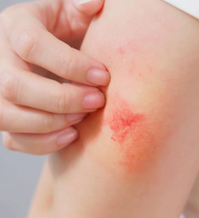 환절기에는 피부가 쉽게 건조해지고 예민해진다. 특히 아토피피부염 환자에게는 증상이 악화하기 쉬운 시기다. 게티이미지뱅크