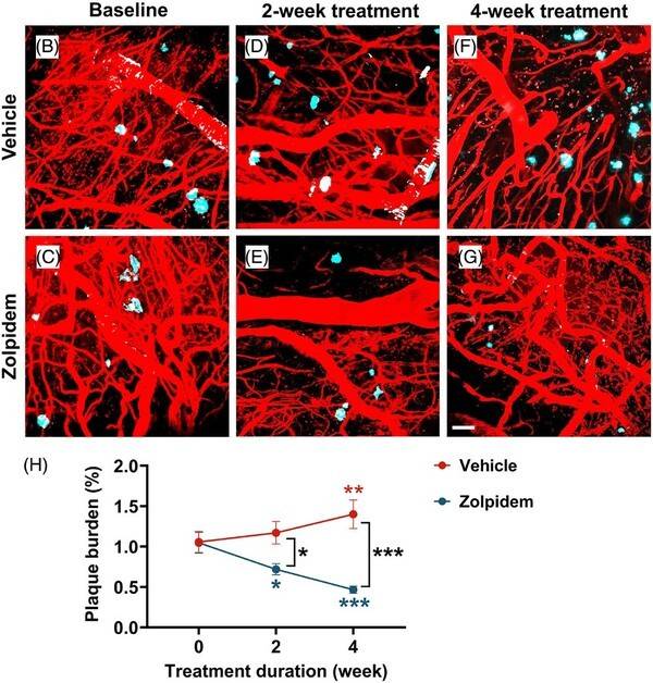 Zolpidem restores sleep and decreases amyloid in a mouse model. Alzheimer's Dement. 2026