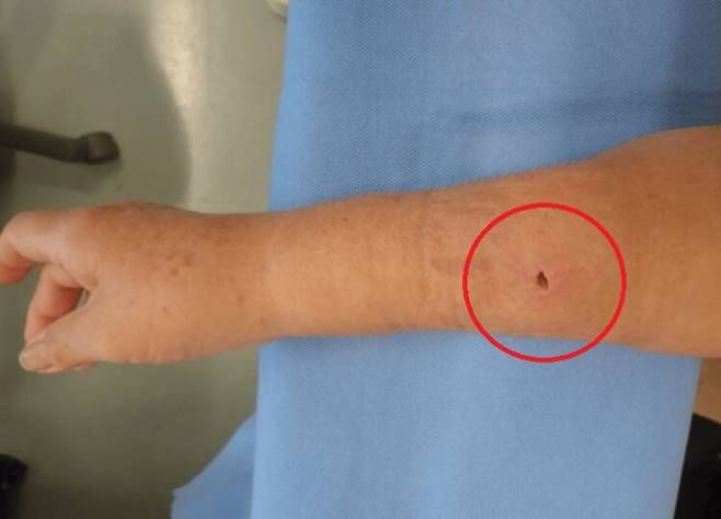 고양이 물림으로 오른쪽 팔뚝에 생긴 상처. 사진=큐레우스(Cureus)