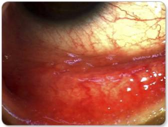 유헹성 각결막염 병변. /사진=국가건강정보포털