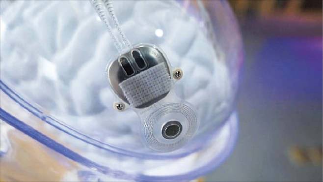 전 세계 최초로 판매 승인을 받은 중국 스타트업 ‘뉴라클’의 침습형 ‘뇌-컴퓨터 인터페이스(BCI)’ 의료기기. /CCTV