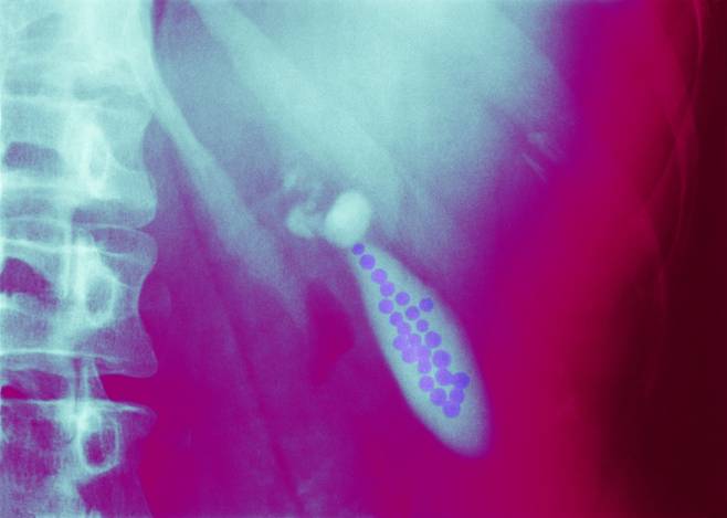 복부 초음파 사진 속 담낭 내부에 작은 담석들이 무리 지어 형성된 모습. 담석은 방치 시 통증과 염증의 원인이 된다. 사진=게티이미지뱅크.