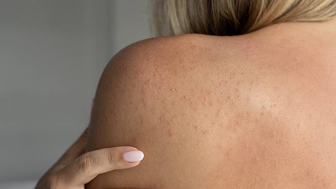 알레르기 반응은 알레르겐뿐만 아니라 장기의 기능 저하와도 관련된다|출처: 게티이미지뱅크