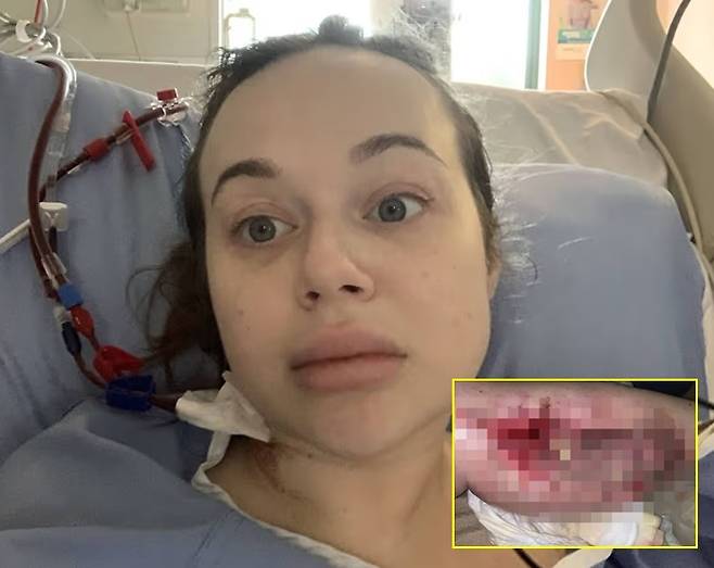 캐나다의 30대 여성이 음주 후 의식을 잃고 잠든 뒤 다리가 심하게 붓는 응급 질환을 겪은 사연이 전해졌다./사진=미러