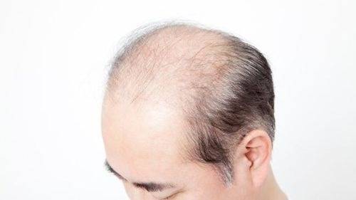 기사 내용의 이해를 돕기 위한 탈모 사진 - 인터넷 커뮤니티