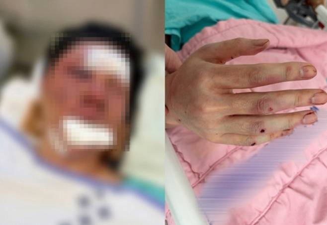 인천 송도국제도시에서 구독자 100만 명의 게임 유튜버 수탉(32·본명 고진호)을 폭행 후 납치한 일당에 대해 검찰이 무기징역을 구형했다. 사진은 다친 수탉의 모습. /사진=유튜버 수탉