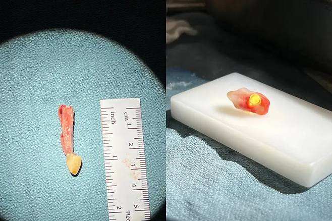 눈에 이식하기 위해 발치한 어금니와 치아와 렌즈를 결합한 복합체. 사진=그렉 몰로니 박사