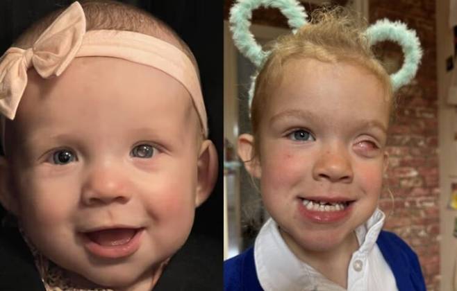 영국 아기 매기는 생후 4개월 이전에 안구암을 발견해 적출 수술을 받았다. 왼쪽 사진에서 베이지색으로 빛나는 매기의 한쪽 눈은 안구암이 발생했을 때 나타나는 대표 증상이다. 사진=더선