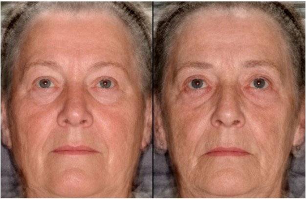 쌍둥이의 얼굴을 비교 평가한 결과, 더 늙어 보이는 사람이 실제로 먼저 사망할 위험이 더 큰 것으로 나타났다. 학술지 BMJ.