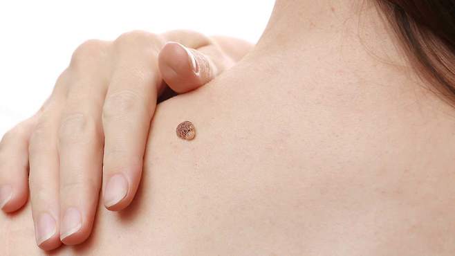 사마귀는 단순 피부 병변이 아닌, 면역 체계와 관련 있다｜출처: 클립아트코리아