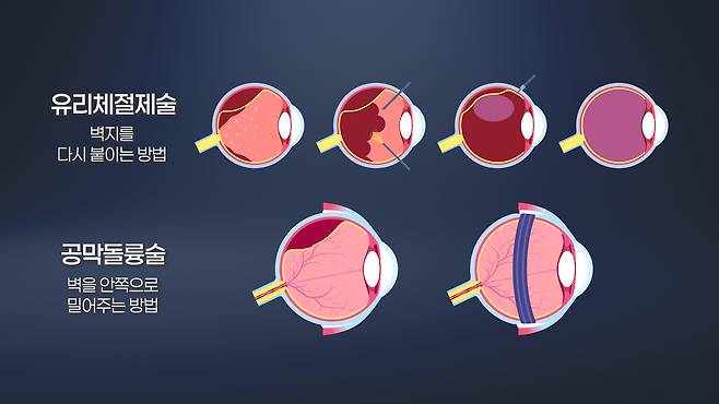 망막박리 수술/서울경제TV캡처