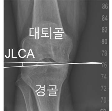 무릎 관절선 수렴각(JLCA) ⓒ서울대병원