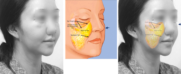 안면윤곽 후 심한 볼처짐이 발생한 전형적인 얼굴입니다. 가쪽의 광대뼈가 아래로 떨어지며 뺨 지방 덩이(malar fat pad)가 미끄러져 내리는 듯한 모습이 확연히 눈에 보입니다.