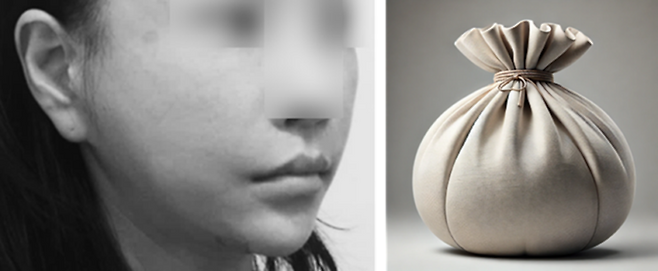 안면윤곽 후 발생한 볼처짐에서 안면거상은, 속은 처져 있고 바깥은 팽팽하게 당겨놓은 '복주머니' 같은 어색한 얼굴형을 만들기 쉽습니다.