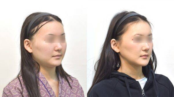 윤곽 수술 후 볼처짐은 뼈를 깎으면 무조건 따라오는 숙명이 아닙니다. 처음부터 처짐이 발생하지 않도록 수술하는 것이 핵심입니다.