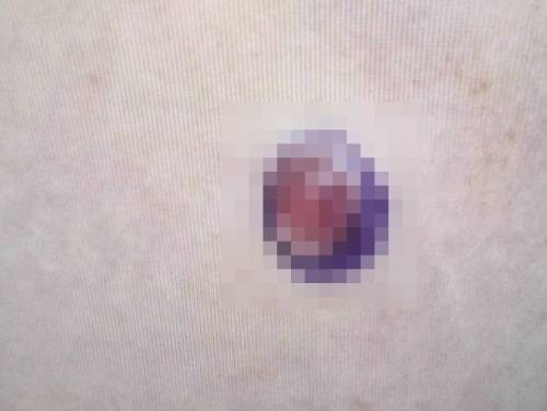 A군의 배에 자라난 뾰루지의 모습. A군을 진료한 의료진이 뾰루지 주변을 펜으로 동그랗게 표시했다. 자료 : 대만 따첸종합병원