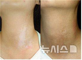 [서울=뉴시스] 백반증(좌)과 세포이식 후(우). (사진= 분당서울대병원 제공)