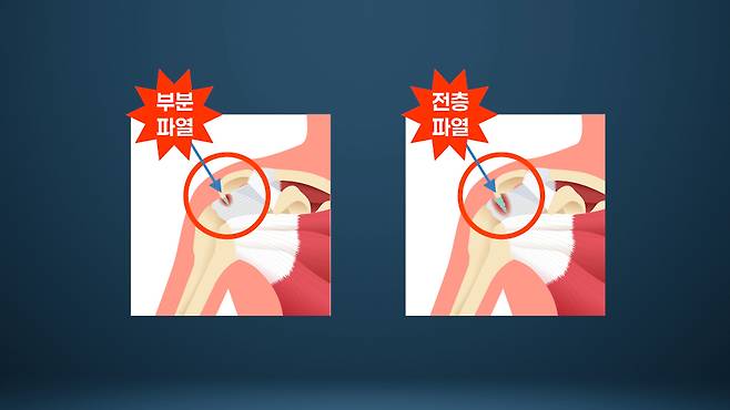 회전근개 부분 파열과 완전 파열/서울경제TV ‘지금, 명의’ 캡처