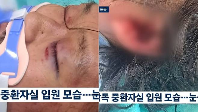 장기기증으로 4명의 생명을 살리고 떠난 고(故) 김창민 감독이 집단폭행을 당한 후 의식을 잃고 병원에 누워 있는 모습. 폭행을 당한 김 감독의 얼굴 곳곳에는 멍이 들었고, 귀에는 피가 고여 있다. ⓒ JTBC 뉴스 캡처