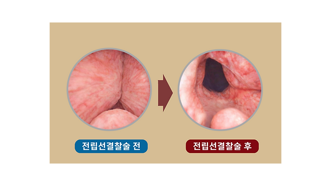 전립선결찰술 시술 전과 후 - 시술 전, 시술 후