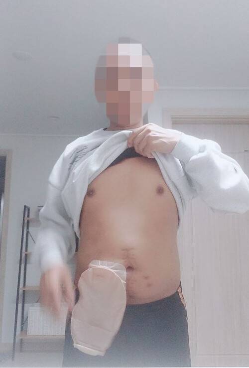 경기 화성시의 한 도금업체에서 일하다 사업주가 항문에 에어건을 발사해 장기가 손상된 타이 출신 노동자 ㄱ씨. ㄱ씨 제공.