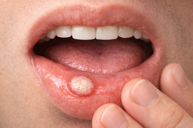 구내염을 앓으면 따갑고 화끈거리는 통증이 느껴진다. 게티이미지뱅크 제공
