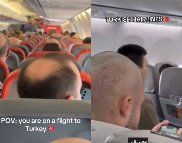 의료관광 대국인 튀르키예에서 모발이식 시술을 받는 글로벌 고객들이 많은 것으로 전해졌다. 엑스(X) 캡처