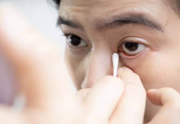 아침에 끈적한 눈곱이 자주 끼는 증상이 심할 경우 시력 저하를 넘어 실명으로까지 이어질 수 있다는 전문의 설명이 나왔다. 사진은 본 기사 내용과 무관. [사진=MyVision.org]
