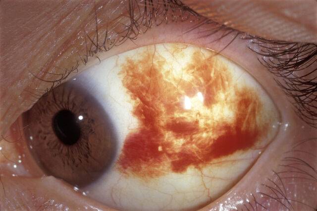 결막하출혈. 클립아트코리아