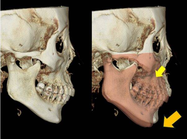위턱(상악골)이 길어지면 아래턱이 시계방향으로 회전하면서 턱 끝은 뒤로 빠져 '무턱'의 형태가 됩니다.
