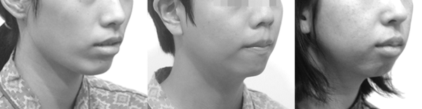 상악골이 길면 턱끝이 뒤로 빠지면서 무턱이 되기 쉽습니다. 중안부 긴 얼굴이 처져 보이는 느낌의 대부분은 사실 이 '무턱'에서 옵니다.