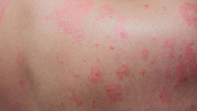 대상포진은 피부에 발진이 생기는 것을 넘어, 칼로 베는 듯한 극심한 신경통을 동반한다. 게티이미지뱅크