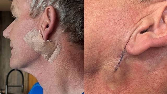 세계적인 셰프 고든 램지(59)는 피부암 제거 수술을 받았다며 선크림의 중요성을 강조했다. 고든 램지 인스타그램