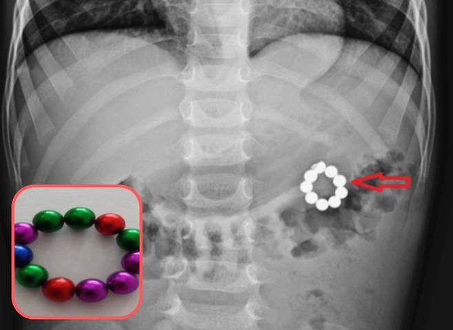 5세 아이가 구슬 모양 자석을 삼켜 결국 개복 수술까지 받았다. 엑스레이 사진에 보이는 체내 자석들. 왼쪽 아래 사진은 아이가 삼킨 것과 같은 자석 장난감. 사진=큐레우스(Cureus)