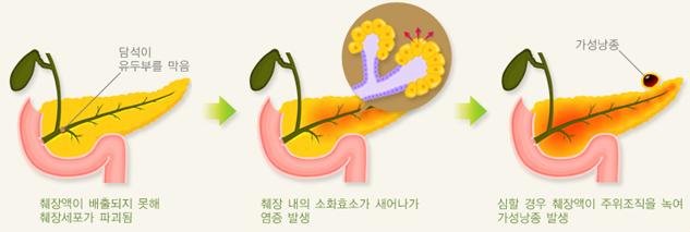 담석이 급성 췌장염을 일으키는 과정의 모식도. 국가건강정보포털