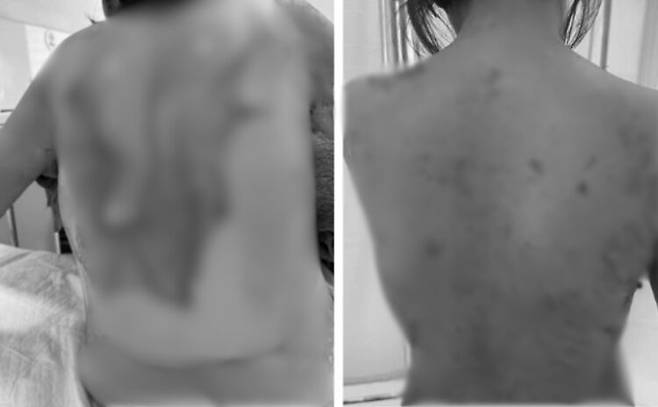 라이엘 증후군으로 등 피부가 벗겨졌던 여성의 치료 전(왼쪽), 후 사진. 사진=베트남-스웨덴 우옹비 병원 홈페이지 캡처