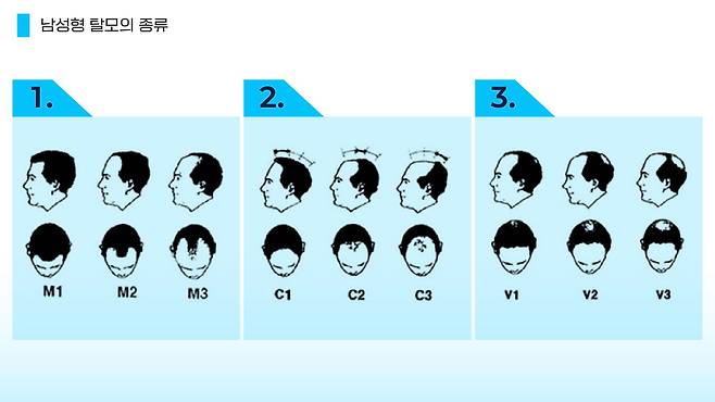 남성형 탈모의 종류. M자 타입, 이마부터 벗겨지는 타입, 정수리부터 벗겨지는 타입 등으로 크게 나눌 수 있다. 처음 굵던 머리는 3~6년 정도 자라다 다시 빠지는데, 그다음 나온 모발의 교체 주기는 이보다 짧은 1년 정도로 줄어든다. 이 과정이 반복되면서 모발이 가늘어지고 결국 솜털처럼 변하면서 탈모가 일어난다. 이민서 그래픽.