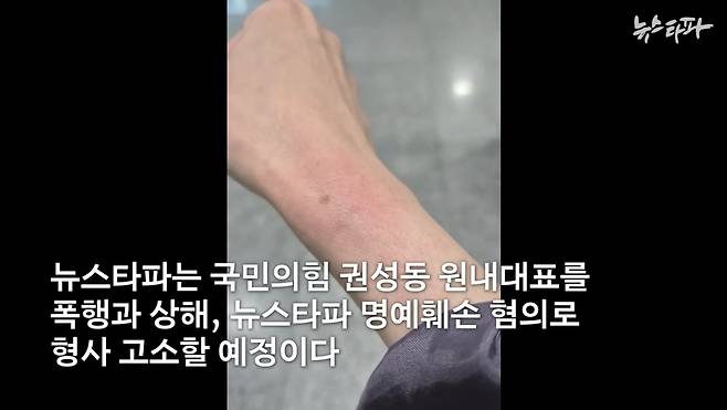 권성동 국민의힘 당시 원내대표에 의해 잡힌 이명주 뉴스타파 기자 손목이 부어오른 모습. /뉴스타파 유튜브