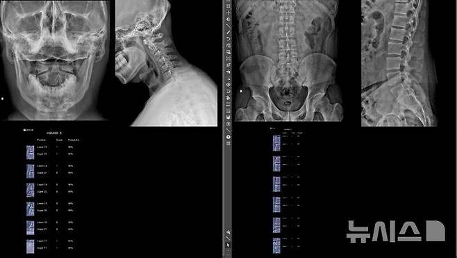 [서울=뉴시스] 강직척추염 환자의 엑스레이(X-ray) 사진을 이승훈 교수가 개발한 인공지능(AI) 딥러닝 모델을 적용하면, 경추와 요추의 척추체 모서리 24개 부위를 자동분석해 염증 정도의 정량화가 6초만에 가능하다. (사진= 한양대학교병원 제공)