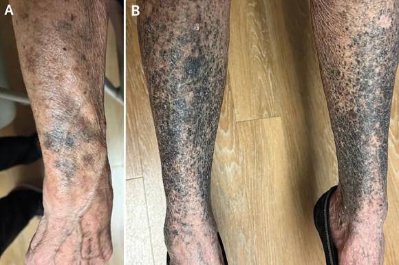 파란 반점이 생긴 A씨의 손(A)과 다리(B). [사진=The New England Journal of Medicine]