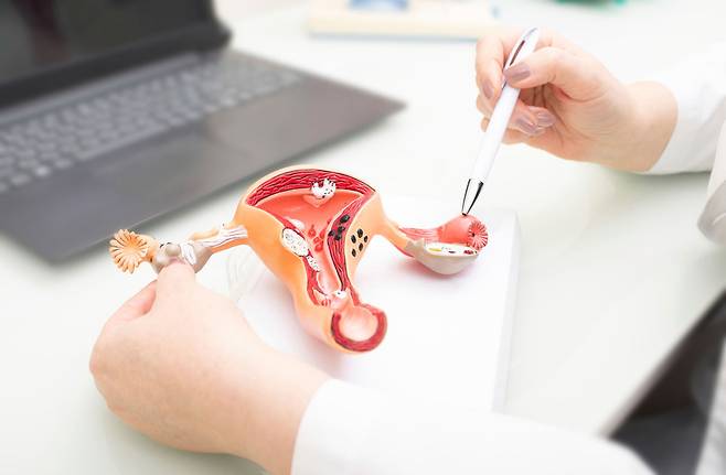 ‘다낭성 난소 증후군(PCOS, Polycystic Ovary Syndrome)’의 정식 명칭이 변경된다./사진= 클립아트코리아