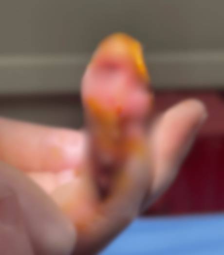 10세 여아가 손톱을 물어뜯는 습관 때문에 손가락 뼈까지 세균 감염이 일어난 사례가 저널에 실렸다. 사진=큐레우스(Cureus)